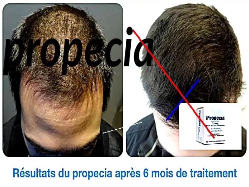 Générique propecia